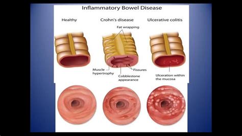 inflammatory bowel disease git july 7 2020 dr shanmuganathan youtube