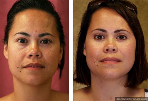 Before and after gallery of specific procedures performed by dr. Patient #9888 Asian Eyelid Surgery (Blepharoplasty) Before ...