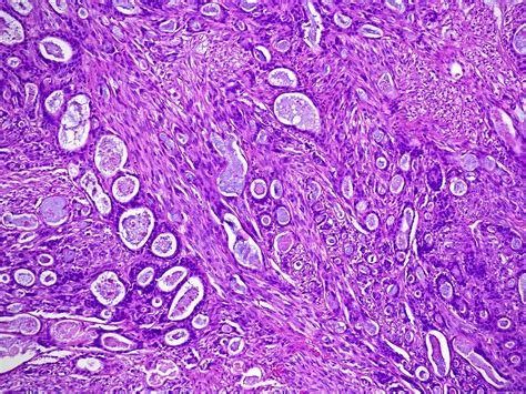 Pathology Outlines Epithelial Myoepithelial Carcinoma