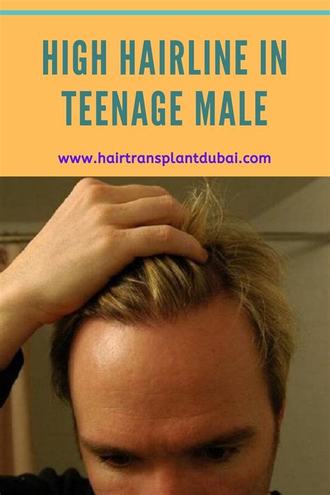 High Hairline in Teenage Male | Hair Transplant Dubai ...