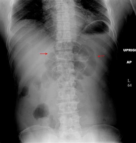 Condition Specific Radiology Localized Ileus Stepwards