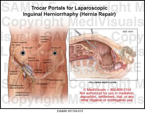 Medivisuals Trocar Portals For Laparoscopic Inguinal Herniorrhaphy