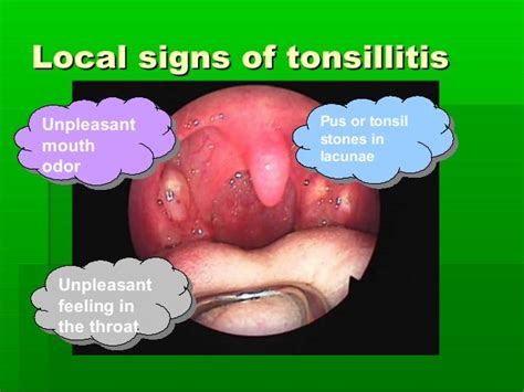 Tonsillitis Types