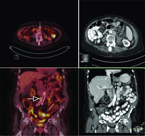 Petct Images Left Showing Metastatic Paraaortic Lymph Node Overseen