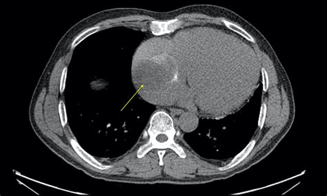 Cureus Atypical Presentation Of A Right Atrial Myxoma