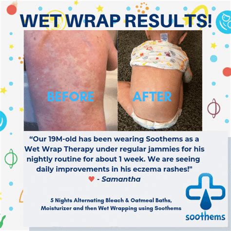 Eczema Sleeves For Babies Wet Wrap Bandages For Elbows And Knees