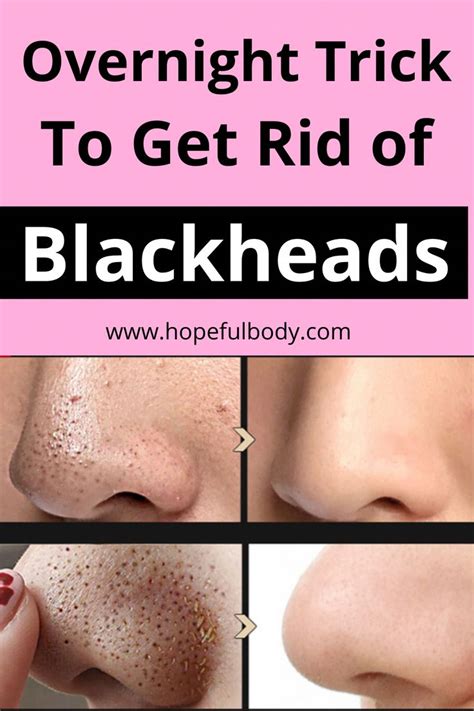 10 Simple And Easy Home Remedies To Get Rid Of Blackheads In 2020 Get
