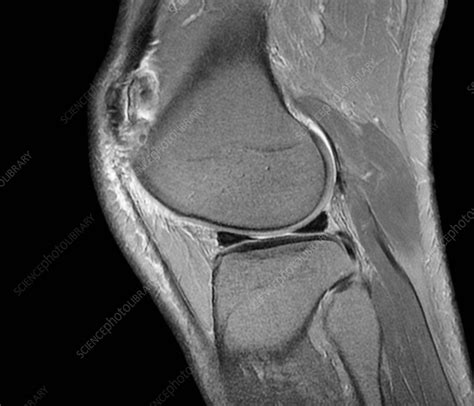 Normal Knee Mri Scan Stock Image C0261161 Science Photo Library
