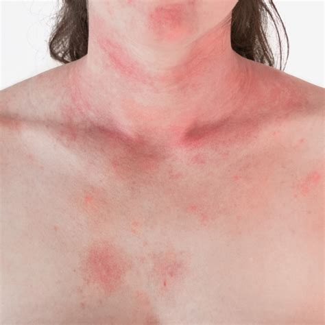 Common Adult Skin Rashes Symptoms Causes Treatment Gambaran