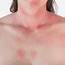 Treatments For Rashes In New York City  Park Avenue Skin Care