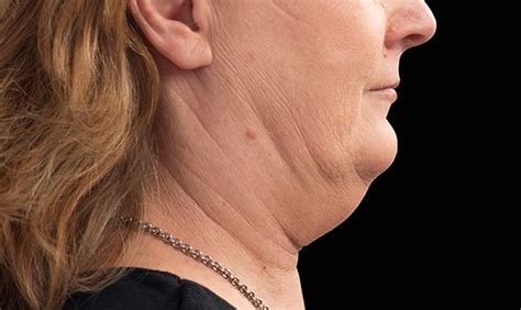 Fat Dissolving Injections For The Under Chin In Sydney Contour Clinics