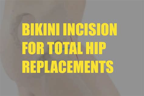 The Bikini Incision For Total Hip Replacements Dr Chien Wen Liew