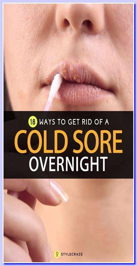 How To Get Rid Of A Cold Sore Overnight Without Medicine In 2022 Cold