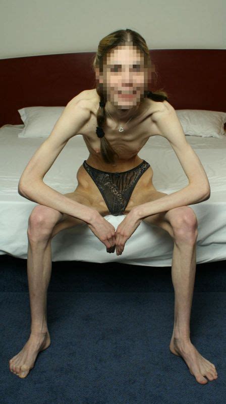 Anorexic Nudes Telegraph