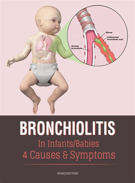 Bronchiolitis In Babies Causes Symptoms And Treatment