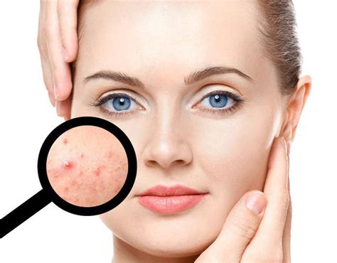 Does Hormonal Birth Control Cause Acne Holladay Dermatology