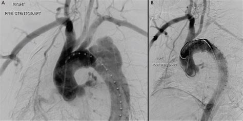 Optimizing Tevar Outcomes In Acute And Subacute Type B Aortic