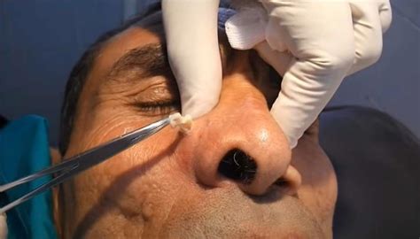 Epidermoid Cyst Removal From Nose New Pimple Popping Videos