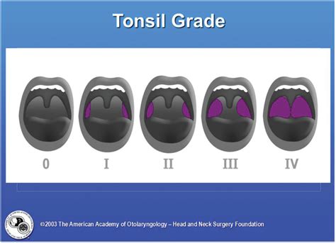 Clinical Practice Guideline Tonsillectomy In Children Update Ron B