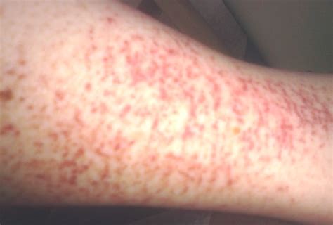 Red Spots On Lower Legs Pictures Photos