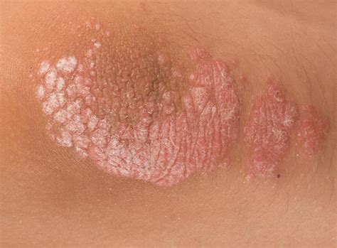 Rash On Neck Meaning Causes Itchy Red Bumpy Rash Diagnosis And