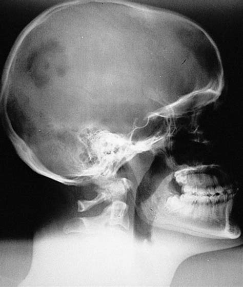 Image Eosinophilic Granuloma Of The Skull Msd Manual Professional
