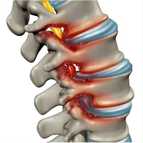 Spinal Stenosis : What is Spinal Stenosis | Spinal ...