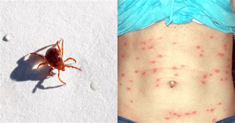 Chigger Bites Pictures Symptoms Prevention And Treatment Marham