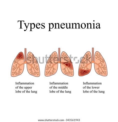 Pneumonia Anatomical Structure Human Lung Type Stock Illustration