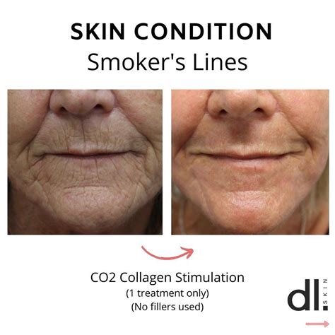 Skincare Tips W Dr Davin Lim On Instagram Smokers Lines Is A