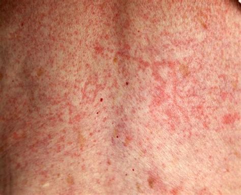 Pictures Of Skin Rashes Lovetoknow