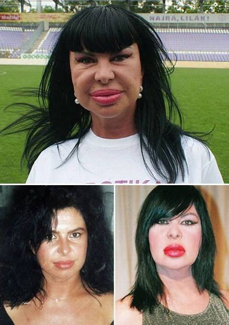 Worst Plastic Surgery Makeovers Plastic Surgery Gone Wrong Bad
