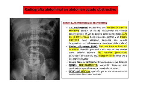 Radiografía Abdominal En Un Abdomen Agudo Obstructivo Rafael Fernando