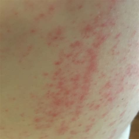What Could This Red Rash And Itchiness In My Groin Be Photo Human