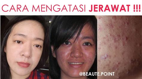 Rock, acne, coal, brick, stone, bedrock, gemstone, gallstone, foot stone. JERAWAT SUSAH SEMBUH ??? KORBAN JERAWAT! // TIPS ...