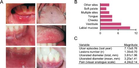Clinical Manifestations Of Recurrent Aphthous Stomatitis A Download Scientific Diagram