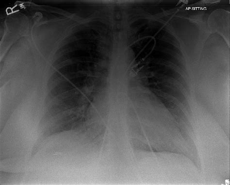 Cxr Mild Cardiomegaly With Increased Parahilar Vascularity Download