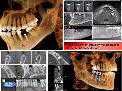 Cone Beam Computed Tomography Cbct Pasadena Tx Implants