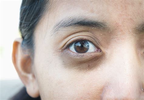 Dry Skin Around Eyes Heres How To Hydrate The Skin Around Eyes