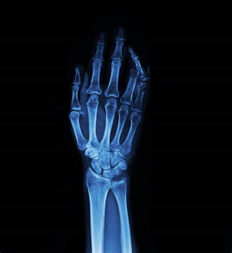 2600 Wrist Xray Stock Photos Pictures And Royalty Free Images Istock