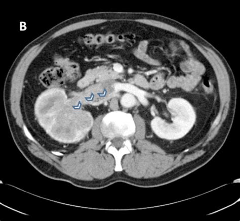 Vascular Extension From An Infiltrating Renal Tumor