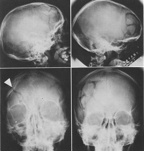 Primary reconstruction of depressed frontal skull ...