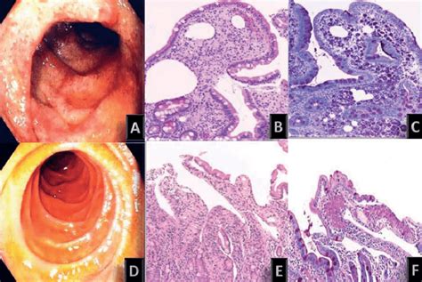 Erythematosus Duodenal Mucosa With Diffuse Haemorrhagic Suffusions A