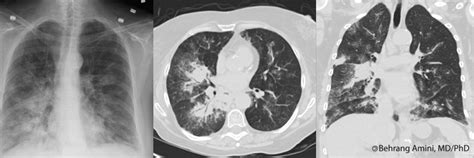 Roentgen Ray Reader Organizing Pneumonia Causes And Associations