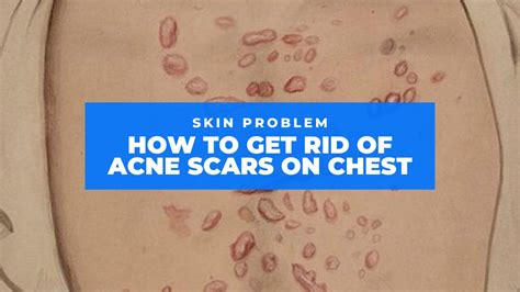 9 Easy Ways How To Get Rid Of Acne Scars On Chest Natural And Medical