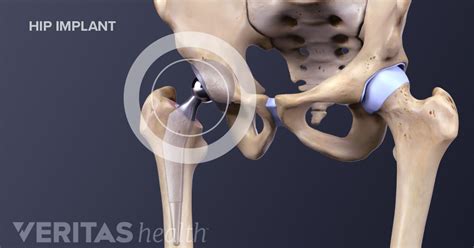 Is Outpatient Hip Replacement Right For You