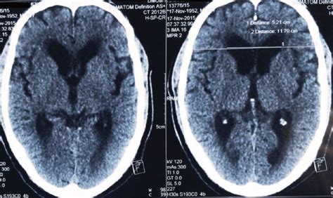 Ct Of The Head Showing Marked Obstructive Hydrocephalus Download