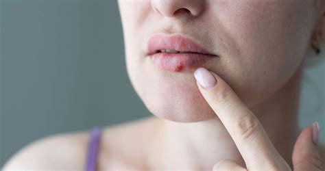 Cold Sores Types Symptoms Causes Diagnosis Treatment And More