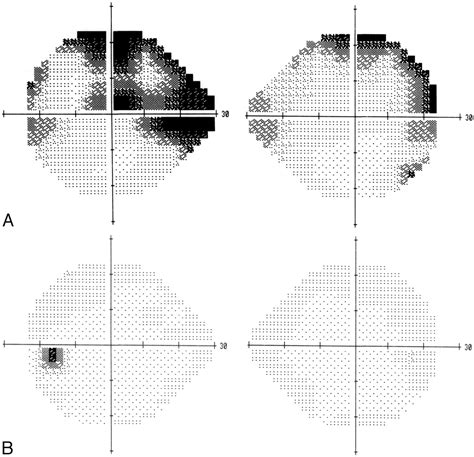 Cortical Blindness Visual Field Blinds