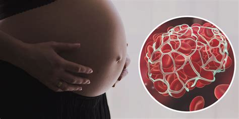 Auses And Symptoms Of Blood Clot During Pregnancy In Hindi